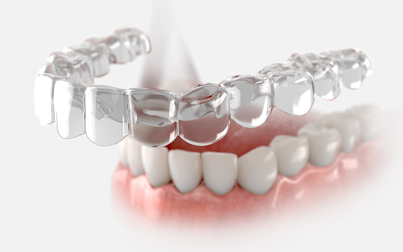 How A Custom Mouthguard Can Keep Your Smile Protected 